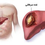 در رژیم غذایی سرطان کبد از این مواد غذایی استفاده کنید