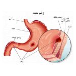 علائم زخم معده چیست