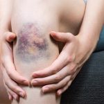 هماتوم چیست؟ | بررسی، علت