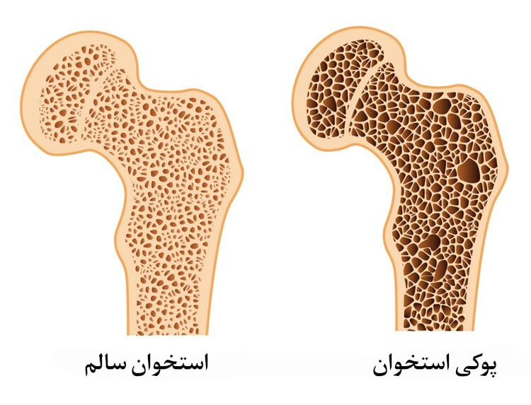 پوکی استخوان با بیمارستان مجازی