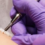 سوزاندن زگیل تناسلی با الکتروکوتر