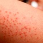 سپسیس یا عفونت خونی چیست و چرا یکی از دلایل شایع بستری در ICU است؟